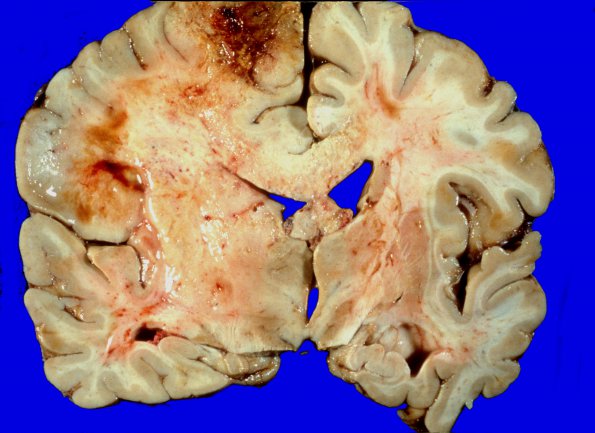 6A5 GBM (Case 6) 1