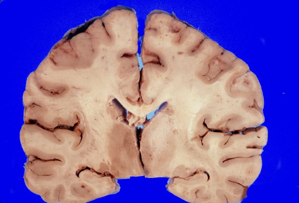 7A1 GBM (Case 7) Infiltration 1