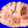 8A1 GBM & Uncal & cingulate hernition (Case 8) 5