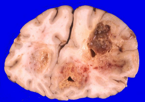 8A1 GBM & Uncal & cingulate hernition (Case 8) 5