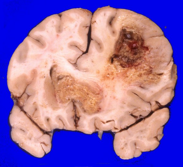 8A2 GBM & Uncal & cingulate hernition (Case 8) 4