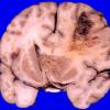 8A3 GBM & Uncal & cingulate hernition (Case 8) 1