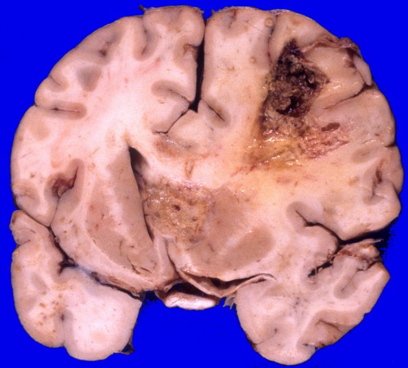 8A3 GBM & Uncal & cingulate hernition (Case 8) 1