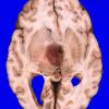 9A1 Glioblastoma (Case 9) 1