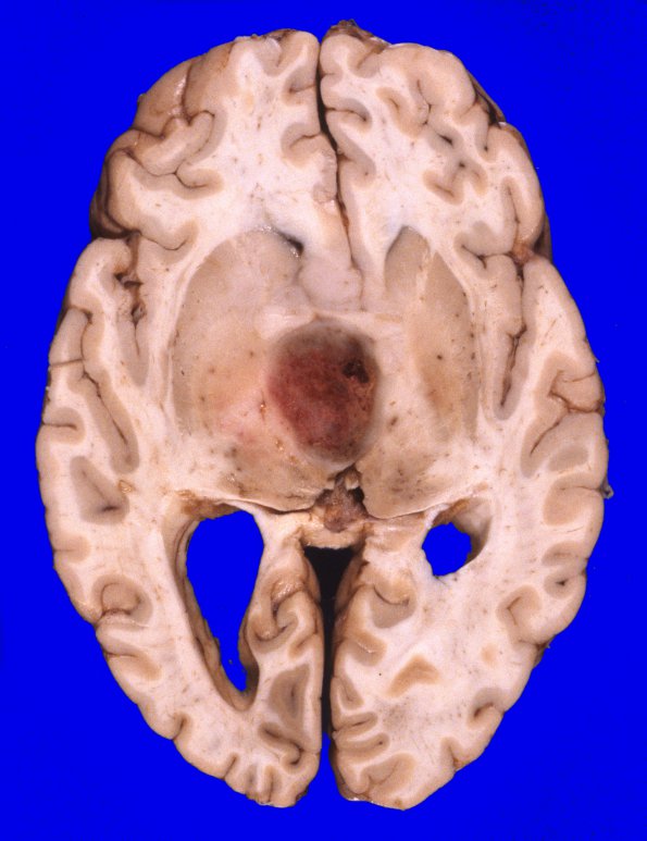 9A1 Glioblastoma (Case 9) 1