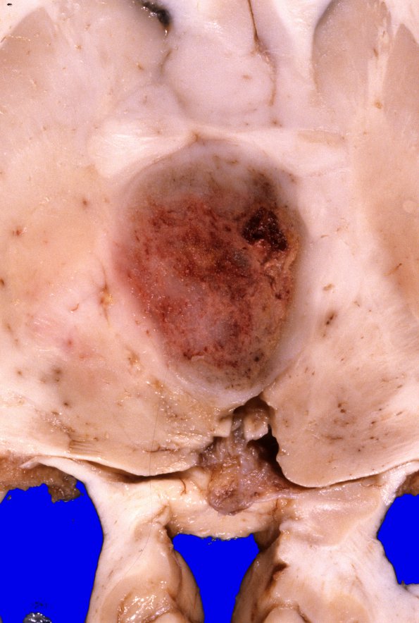 9A2 Glioblastoma (Case 9) 7