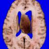 9A3 Glioblastoma (Case 9) 2