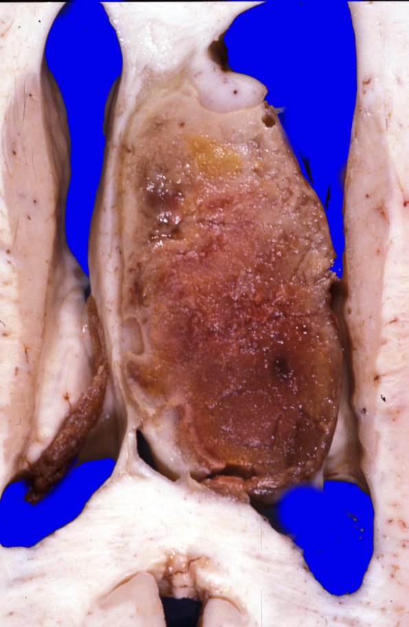 9A4 Glioblastoma (Case 9) 2A