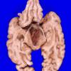 9A5 Glioblastoma (Case 9) 4