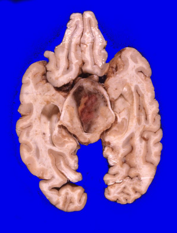 9A5 Glioblastoma (Case 9) 4