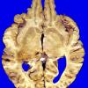 9A6 Glioblastoma (Case 9) 5