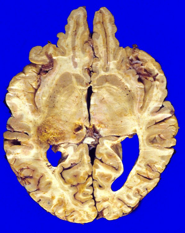 9A6 Glioblastoma (Case 9) 5