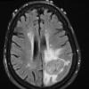 10A1 Gliosarcoma, adenoid features (Case 10) FLAIR - Copy