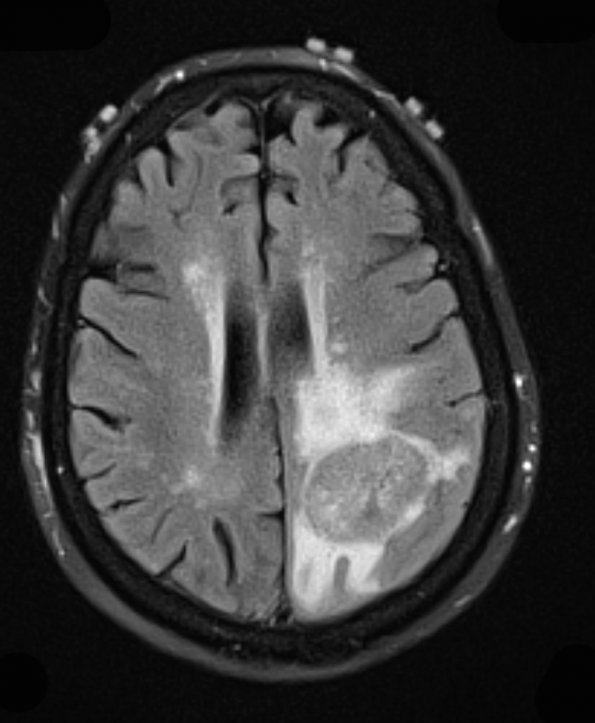 10A1 Gliosarcoma, adenoid features (Case 10) FLAIR - Copy