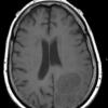 10A2 Gliosarcoma, adenoid features (Case 10) T1 - Copy