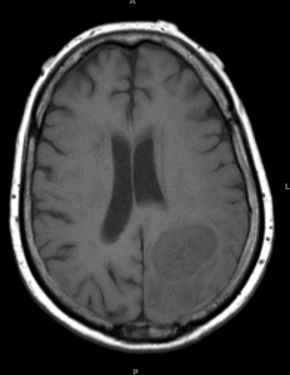 10A2 Gliosarcoma, adenoid features (Case 10) T1 - Copy