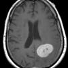 10A3 Gliosarcoma, adenoid features (Case 10) T1 W - Copy