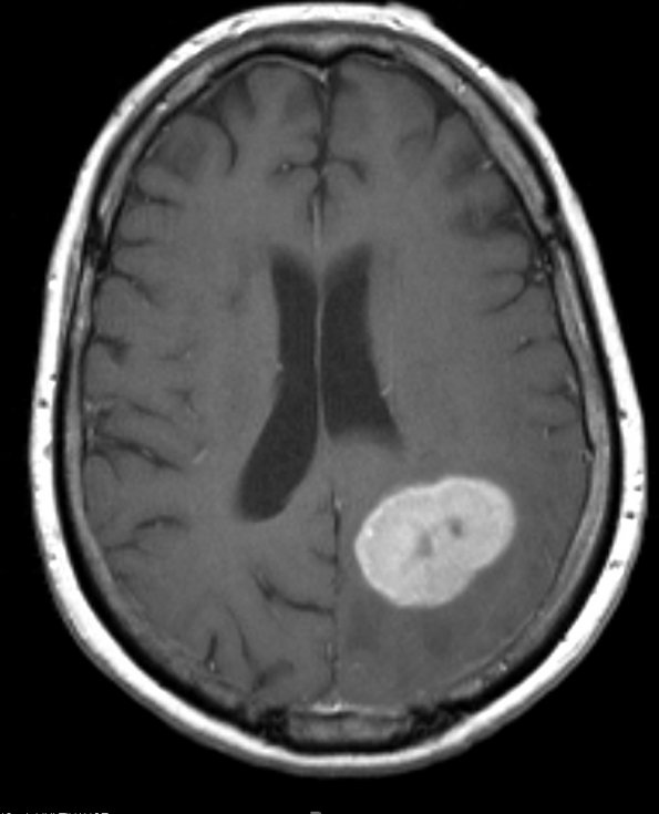 10A3 Gliosarcoma, adenoid features (Case 10) T1 W - Copy