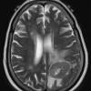 10A4 Gliosarcoma, adenoid features (Case 10) T2 W - Copy