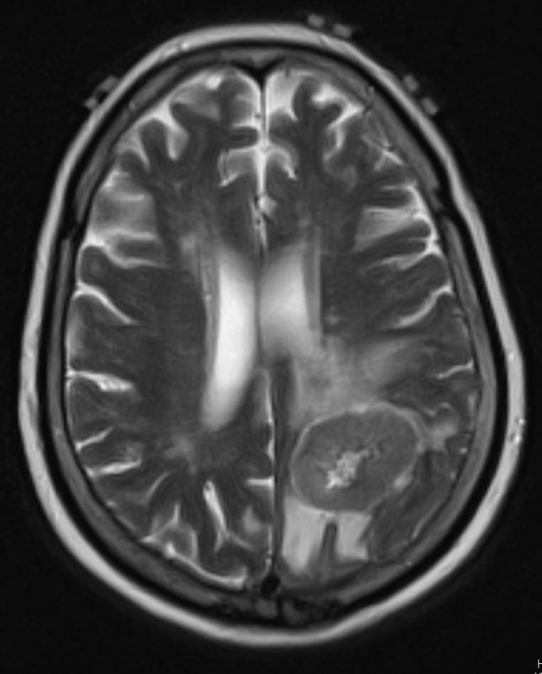 10A4 Gliosarcoma, adenoid features (Case 10) T2 W - Copy