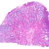 10B1 Gliosarcoma, adenoid features (Case 10) 1 H&E WM