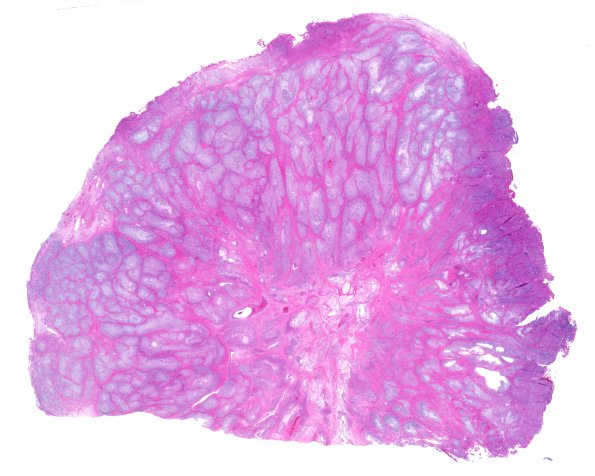 10B1 Gliosarcoma, adenoid features (Case 10) 1 H&E WM