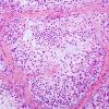 10B3 Gliosarcoma, adenoid features (Case 10) H&E 4