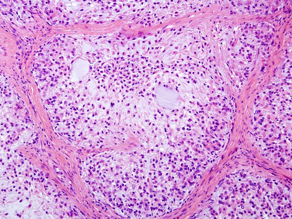 10B3 Gliosarcoma, adenoid features (Case 10) H&E 4