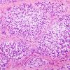 10B4 Gliosarcoma, adenoid features (Case 10) H&E 6