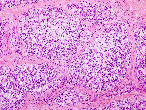 10B4 Gliosarcoma, adenoid features (Case 10) H&E 6