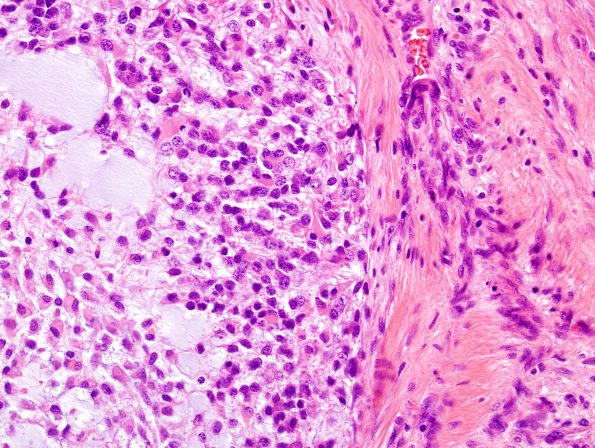 10B5 Gliosarcoma, adenoid features (Case 10) H&E 8