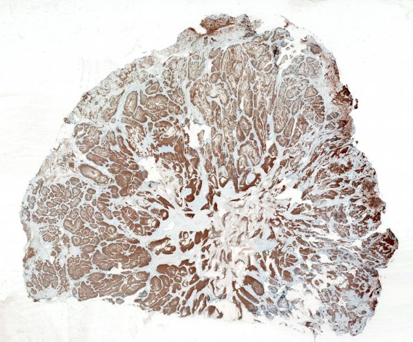 10C1 Gliosarcoma, adenoid features (Case 10) 1 GFAP WM