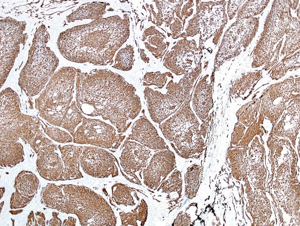 10C2 Gliosarcoma, adenoid features (Case 10) GFAP 7