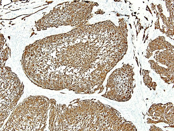 10C3 Gliosarcoma, adenoid features (Case 10) GFAP 4