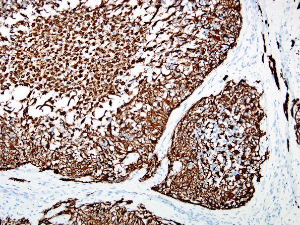 10C4 Gliosarcoma, adenoid features (Case 10) GFAP 3