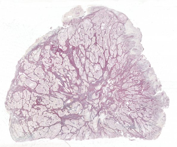 10D1 Gliosarcoma, adenoid features (Case 10) 1 Retic WM