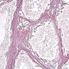 10D2 Gliosarcoma, adenoid features (Case 10) Retic 2