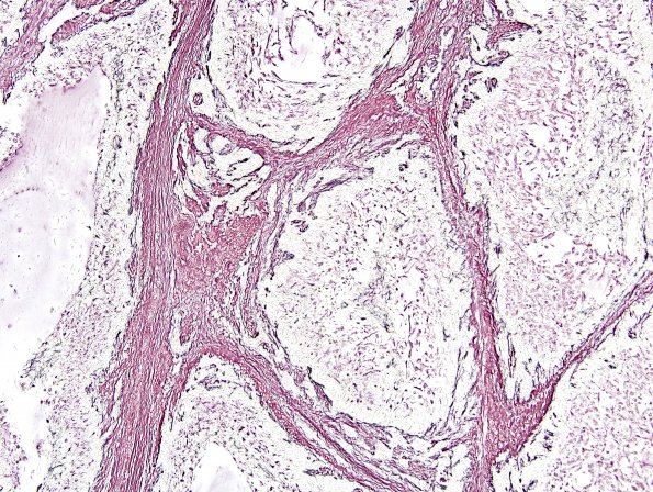 10D2 Gliosarcoma, adenoid features (Case 10) Retic 2