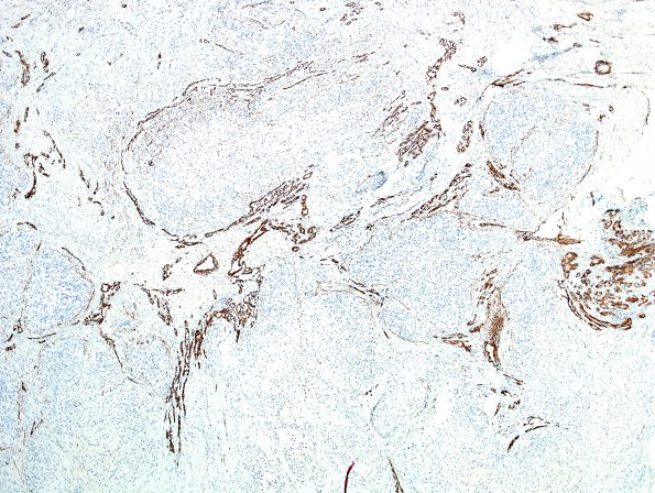 10E1 Gliosarcoma, adenoid features (Case 10) SMA 3