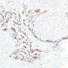 10E2 Gliosarcoma, adenoid features (Case 10) SMA 5