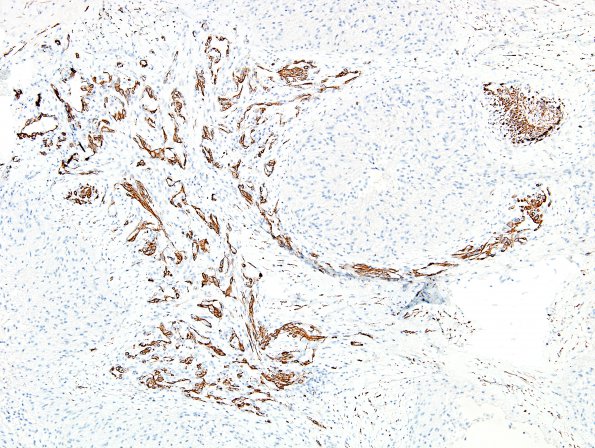 10E2 Gliosarcoma, adenoid features (Case 10) SMA 5