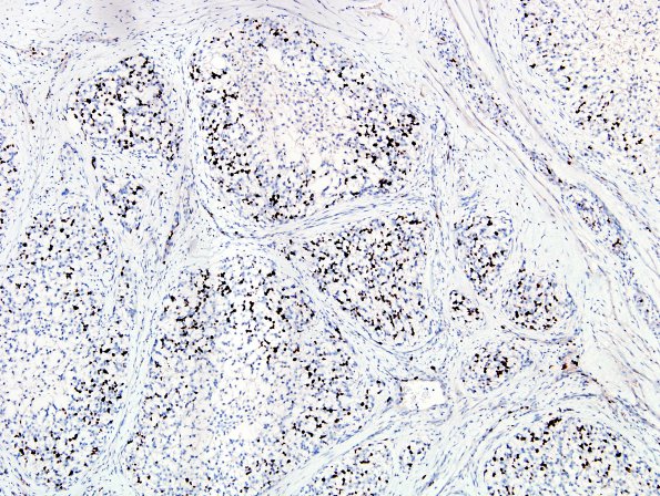 10F2 Gliosarcoma, adenoid features (Case 10) Ki67 2