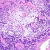 11A1 Gliosarcoma-PNET-Adenoid var (Case 11)  H&E 7