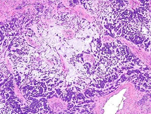 11A1 Gliosarcoma-PNET-Adenoid var (Case 11)  H&E 7