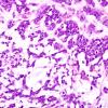 11A2 Gliosarcoma-PNET-Adenoid var (Case 11)  H&E 2