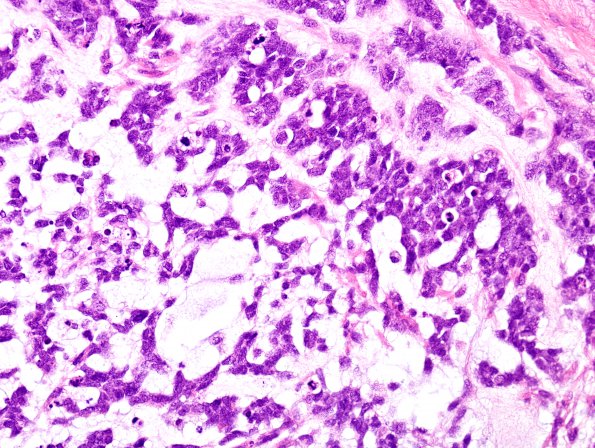 11A2 Gliosarcoma-PNET-Adenoid var (Case 11)  H&E 2