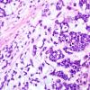 11A3 Gliosarcoma-PNET-Adenoid var (Case 11)  H&E 5