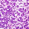 11A4 Gliosarcoma-PNET-Adenoid var (Case 11)  H&E 1