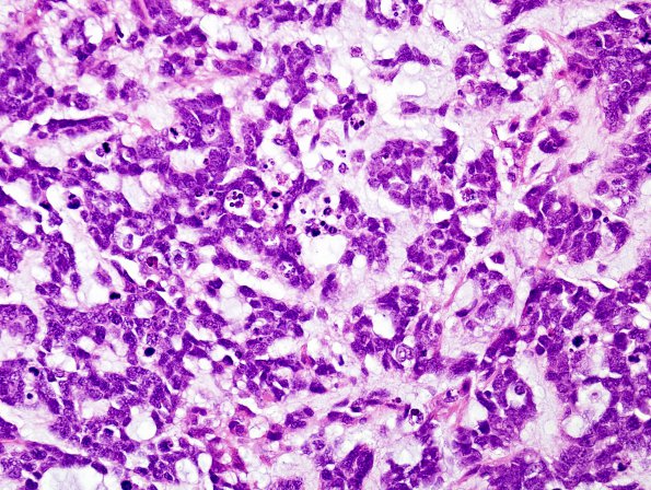 11A4 Gliosarcoma-PNET-Adenoid var (Case 11)  H&E 1