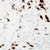 11B1 Gliosarcoma-PNET-Adenoid var (Case 11) GFAP label D2